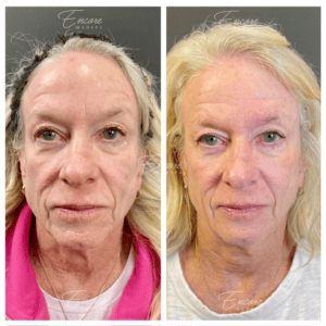 sculptra treatment face, woman's face before and after